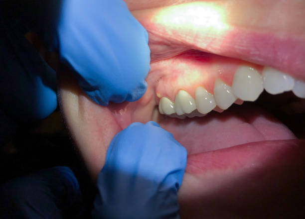 Best Chipped Tooth Repair Near Me  in Stevenson, AL